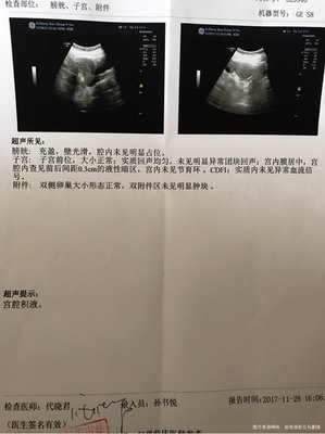 宫腔积液可以怀孕吗