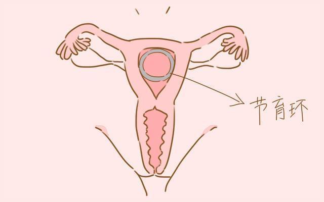 请问上环会怀孕吗