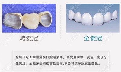 镶一个烤瓷牙多少钱
