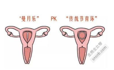 取环多久可以怀孕