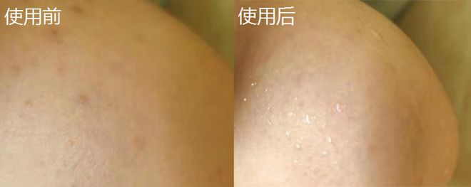 洗粉刺痘痘东西是什么原因