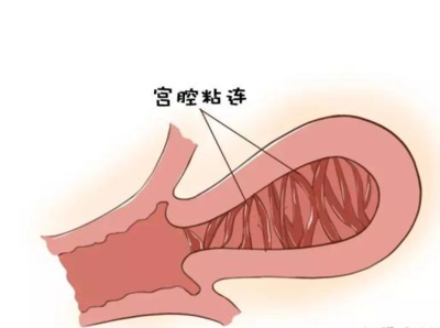 轻度宫腔粘连怎么治疗