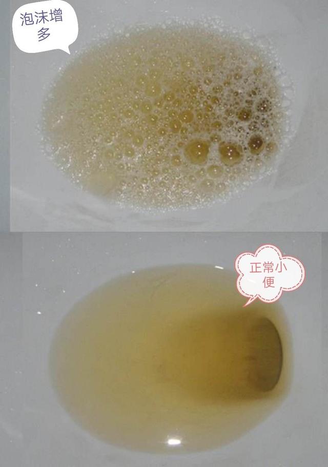 小便发浑是怎么回事