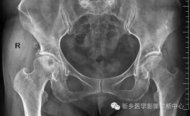 股骨头囊变是怎么回事
