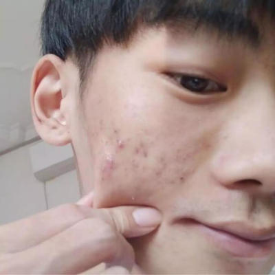 痘痘 痘印怎么处理