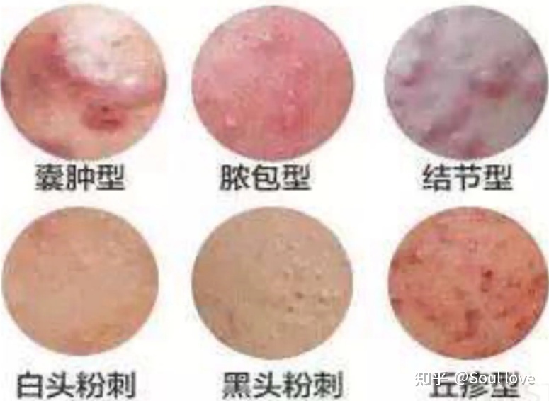下巴总起囊肿型痘痘