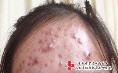 脸上的痘痘忌口鸡么