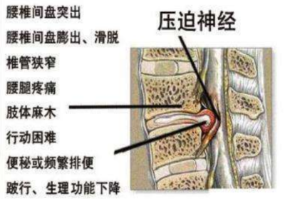 腰间盘突出压迫神经怎么治疗