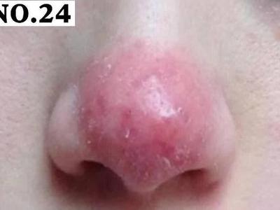 脑门下巴鼻子周围长痘痘