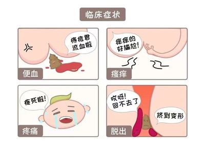 怀孕痔疮