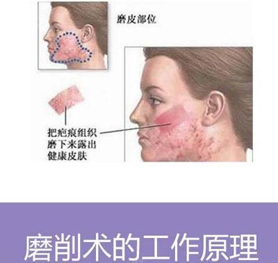 上海激光治疗痘痘