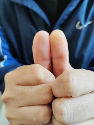 两手大拇指发麻是怎么回事