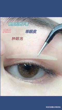 单眼皮肿眼泡怎么贴双眼皮