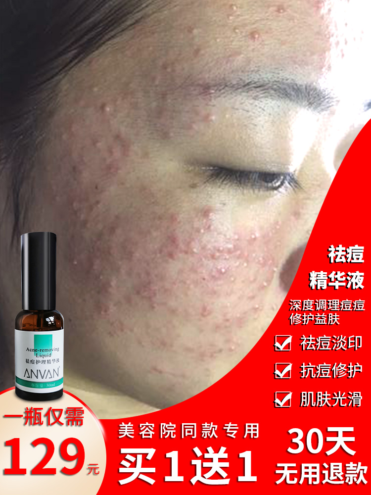 痘痘肌肤用什么牌子最好