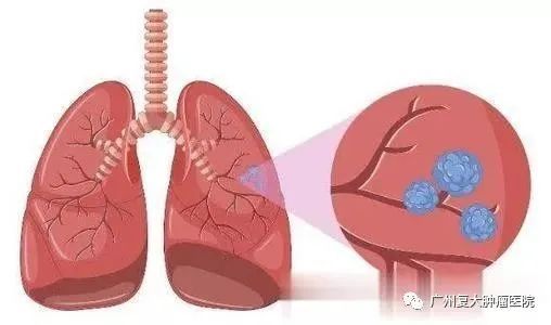 肺有结节怎么治疗
