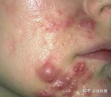 痘痘留下疤痕怎么办