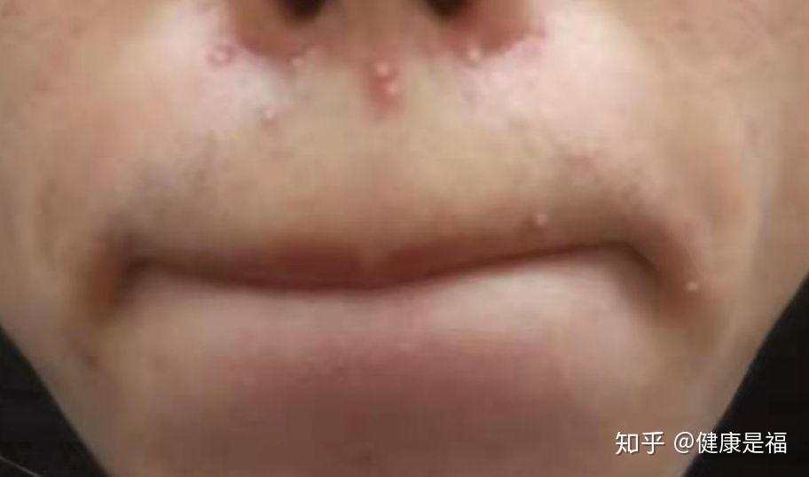 嘴内怎么好像有痘痘