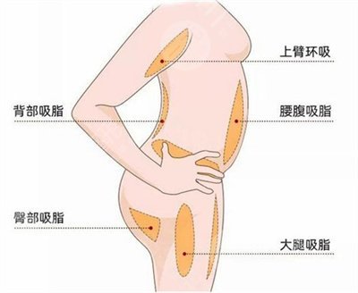 溶脂减肥的费用