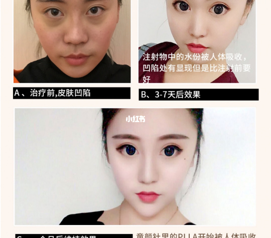 童颜针和水光针的区别