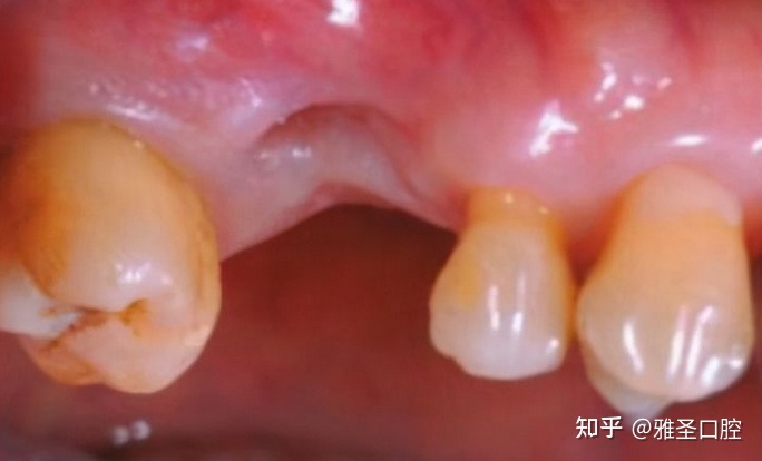 拔牙要多久