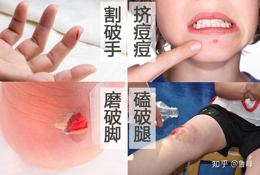 挤痘痘怎么护理