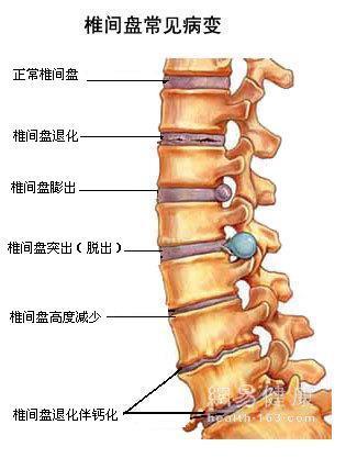 椎间盘膨突出怎么治疗