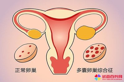 多囊会影响怀孕吗