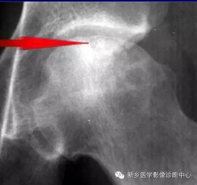 股骨头囊变是怎么回事