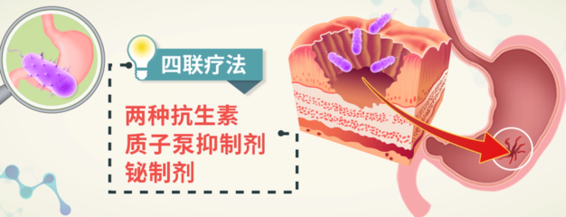 螺杆菌怎么治疗