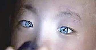 天生蓝眼睛是什么病