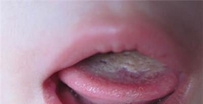 舌苔厚白是怎么回事