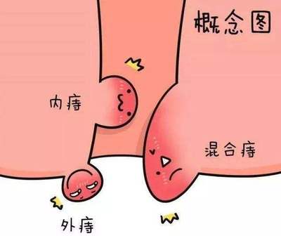 做完痔疮手术多久可以怀孕