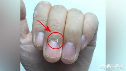 手指甲蜕皮是怎么回事