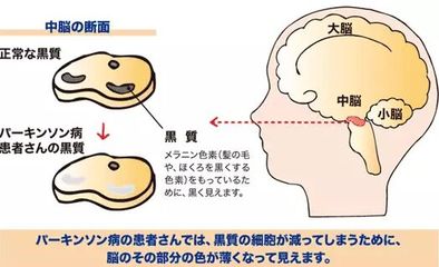 大脑萎缩是怎么回事