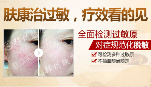 脸部快速脱敏的妙招