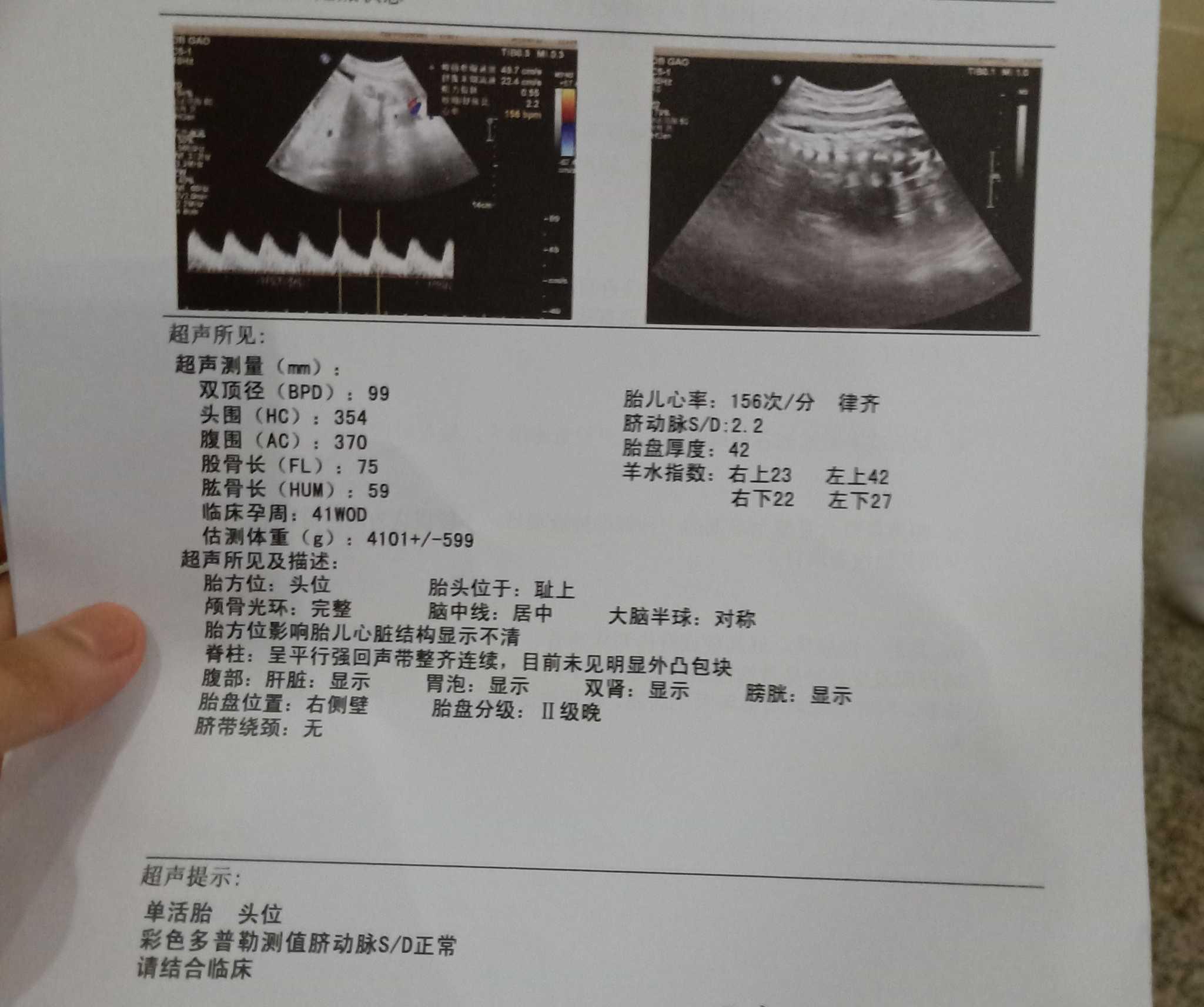 如何检查胎儿是否入盆