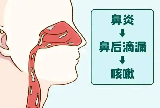 鼻后滴漏咳嗽特点
