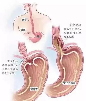 食道反酸是怎么回事