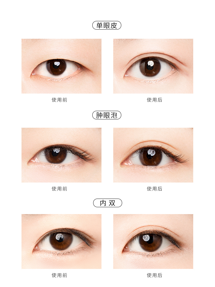 单眼皮肿眼泡怎么贴双眼皮