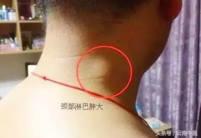头部后面长痘痘是什么原因