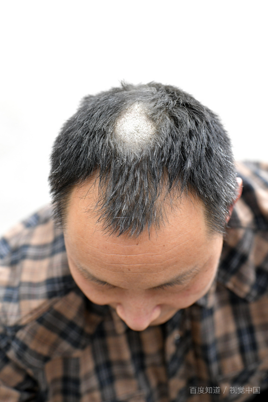 头部后面长痘痘是什么原因