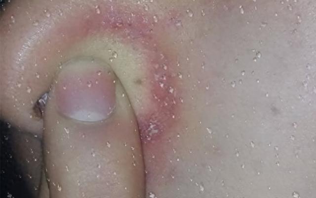 鼻子整个变红长小痘痘