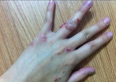孕妇汗疱疹怎么治疗