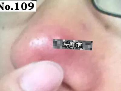 鼻子大痘痘怎么办