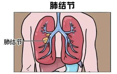 肺结节是怎么回事
